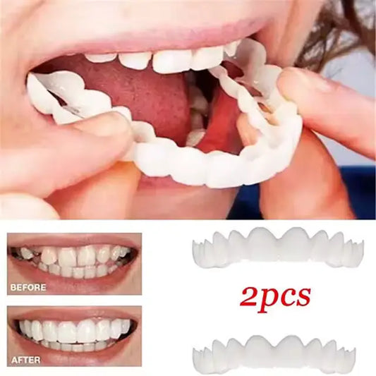 🦷 Carillas Snap On Smile – Superior e Inferior